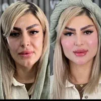 پکیج طلایی نقره ایی برنز لیفت با فیلر ژل بوتاکس|خدمات آرایشگری و زیبایی|مشهد, سناباد|دیوار
