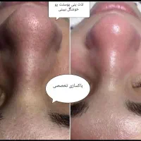 پاکسازی،فیشیال تخصصی،درمان مشکلات پوستی(تخفیف)|خدمات آرایشگری و زیبایی|گرگان, |دیوار