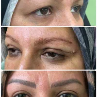 بلفاروپلاستی،ساکشن غبغب،تزریق چربی کاشت مو و ابرو