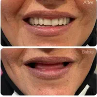 دندان مصنوعی با تعرفه دولتی و اقساط|خدمات آرایشگری و زیبایی|پرند, فاز ۵|دیوار