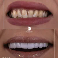 کامپوزیت دندان.لمینت|خدمات آرایشگری و زیبایی|مشهد, کوثر|دیوار