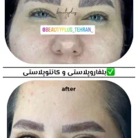 بلفاروپلاستی بخیه لیزری و با بیحسی کامل درمطب پزشک|خدمات آرایشگری و زیبایی|قم, زنبیل آباد|دیوار