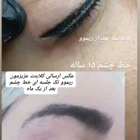 پاک کردن تاتو صورت