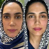 جوانسازی با ژل وفیلر به سبک بالانس فیس و گلو لیفت