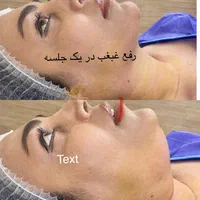 بوتاکس صورت ومعده ژل تزریق چربی عمل پلک ساکشن غبغب|خدمات آرایشگری و زیبایی|یزد, |دیوار