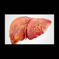 درمان کبد چرب گرید1،2،3