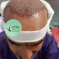 تکنسین کاشت مو هستم