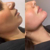 لیپو ساکشن غبغب با متد وی لاین ،بوکال فت ،بلفارو