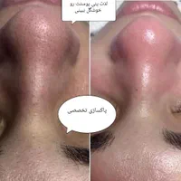 فیشیال و پاکسازی تخصصی ودرمان مشکلات پوستی(تخفیف)|خدمات آرایشگری و زیبایی|گرگان, |دیوار