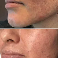 از بین بردن انواع لک صورت|خدمات آرایشگری و زیبایی|فردیس, فردیس|دیوار