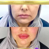 آموزش فیشیال،ژل بوتاکس برای آقاها،خانم هفده شهریور|خدمات آموزشی|تبریز, |دیوار