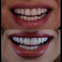 ارائه خدمات کامپوزیت ولمینیت دندان (ونیرکامپوزیت )|خدمات آرایشگری و زیبایی|کرج, مهرویلا جنوبی|دیوار
