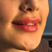 تزریق ژل فیلر بوتاکس چربی و نخ لیفت با قیمت ویژه