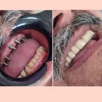 دندانپزشکی ستارخان اقساط ایمپلنت کامپوزیت عصبکشی|خدمات آرایشگری و زیبایی|تهران, صادقیه|دیوار