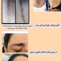 کربن تراپی لیزر کیوسوئیچ بستن منافذ|خدمات آرایشگری و زیبایی|دهدشت, |دیوار