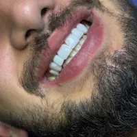 دندانسازی دندانپزشکی کامپوزیت فکی 10درمطب VlP|خدمات آرایشگری و زیبایی|رشت, استقامت ۱|دیوار