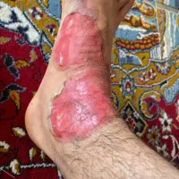 پانسمان زخم درمان انواع زخم با جدیدترین روش روز