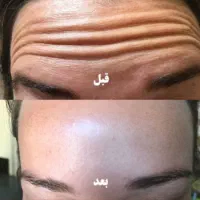 طب سوزنی، بوتاکس، آموزش، مزوتراپی، پلاسماتراپی|خدمات آرایشگری و زیبایی|مشهد, حسابی جنوبی (شهرک غرب)|دیوار