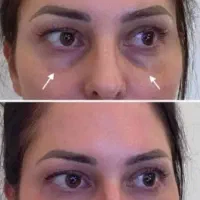 ژل و بوتاکس کاشت ابرو قسطی|خدمات آرایشگری و زیبایی|یاسوج, |دیوار