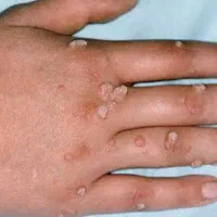 محصول زگیل تناسلی وانواع زگیل|آرایشی، بهداشتی، درمانی|میناب, |دیوار