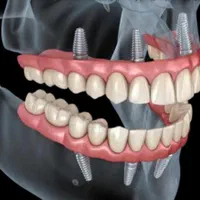 ایمپلنت مهر شفاء|خدمات آرایشگری و زیبایی|قم, حنیف نژاد|دیوار
