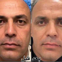 بلفاروپلاستی پلک|خدمات آرایشگری و زیبایی|تهران, یوسف‌آباد|دیوار