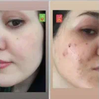 کرم سفیدکننده(آنتی استاین) ترکیب آمپولی|آرایشی، بهداشتی، درمانی|بم, |دیوار