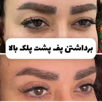 جشنوراه جراحی پلک بالا بلفاروپلاستی