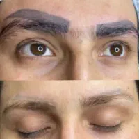 تخفیف ۲۵ درصدی ریموو داخل کلینیک