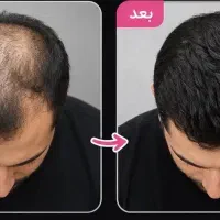 رویش مجدد مو