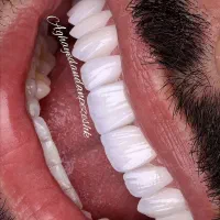 جشنواره دندان ونیر کامپوزیت روکش لمینیت عصب  IMAX