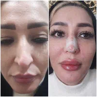 ژل بوتاکس مزو فیلر انزیم فیلر فشیال|خدمات آرایشگری و زیبایی|اسلامشهر, مطهری|دیوار