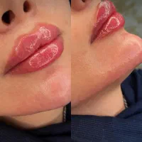جشنواره ژل ،بوتاکس،نخ توسط پزشک انجام لیزر بدن