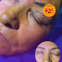 جشنواره ویژه بلفاروپلاستی(جراحی زیبایی پلک)|خدمات آرایشگری و زیبایی|بهبهان, |دیوار