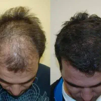 مشاوره تخصصی مو و زیبایی ریزش تاسی و چربی سر نازکی