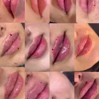 تزریق کار فیلر و ژل