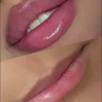 تزریق ژل هر سیسی ۶۵۰ -۵۵۰بوتاکس ۵۵۰ -۶۵۰