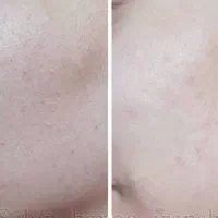 فیشیال کلاسیک و درماپلنینگ