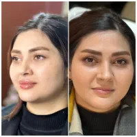ژل لب بوتاکس انزیم هیرفیلر کانتورینگ لیفت صورت|خدمات آرایشگری و زیبایی|تهران, پونک|دیوار