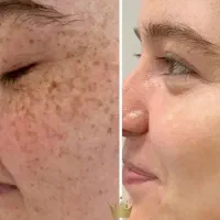 برداشتن خال ،کک و مک ،زیگیل،جوانسازی باآلکاپیل