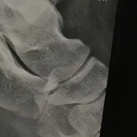 شکسته بندی در کرج و فردیس سیار منزل|خدمات آرایشگری و زیبایی|مشکین‌دشت, |دیوار