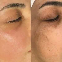 پاکسازی و جوانسازی پوست|خدمات آرایشگری و زیبایی|ورزنه, |دیوار