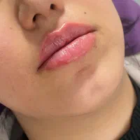 پکیج جوانسازی ملانژ + بوتاکس هدیه