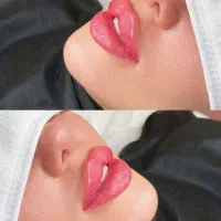 ژل بوتاکس فیلر مزو اقساط با ۵۰٪ تخفیف توسط پزشک