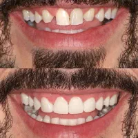 کامپوزیت دندان