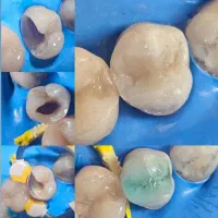 دندانپزشکی/کامپوزیت/عصبکشی/روکش/ترمیم و پالیش|خدمات آرایشگری و زیبایی|قدس, شهرقدس|دیوار