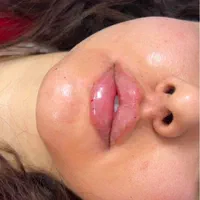 ژل لب ،بوتاکس،آنزیم،فیلر،مزو