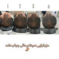 ژل ،بوتاکس،مزوتراپی مو، خال برداری ،لیزر مو|خدمات آرایشگری و زیبایی|اسلام‌شهر, باغ فیض|دیوار