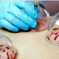 حجامت وبادکش