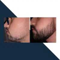 احیای ریش های کم پشت